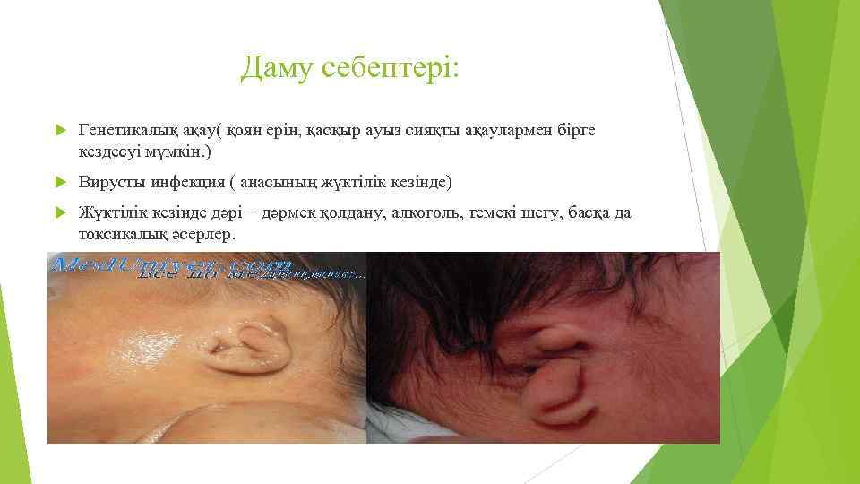 Даму себептері: Генетикалық ақау( қоян ерін, қасқыр ауыз сияқты ақаулармен бірге кездесуі мүмкін. )