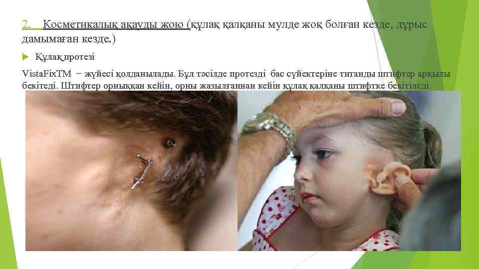 2. Косметикалық ақауды жою (құлақ қалқаны мулде жоқ болған кезде, дұрыс дамымаған кезде. )