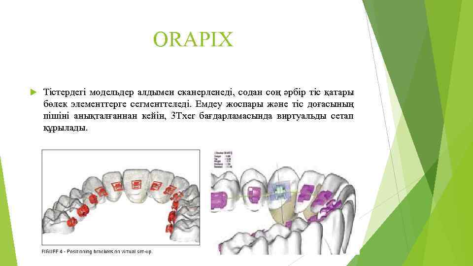 ORAPIX Тістердегі модельдер алдымен сканерленеді, содан соң әрбір тіс қатары бөлек элементтерге сегменттеледі. Емдеу