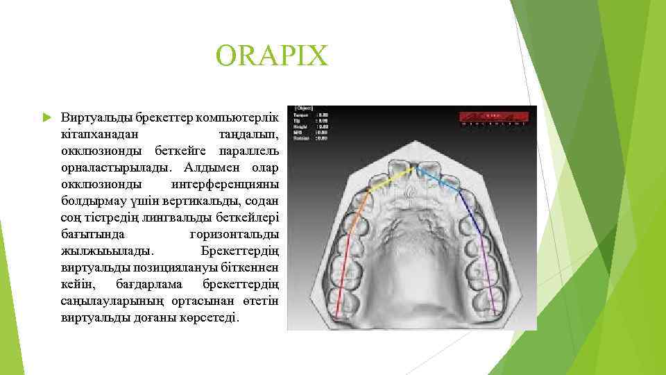 ORAPIX Виртуальды брекеттер компьютерлік кітапханадан таңдалып, окклюзионды беткейге параллель орналастырылады. Алдымен олар окклюзионды интерференцияны