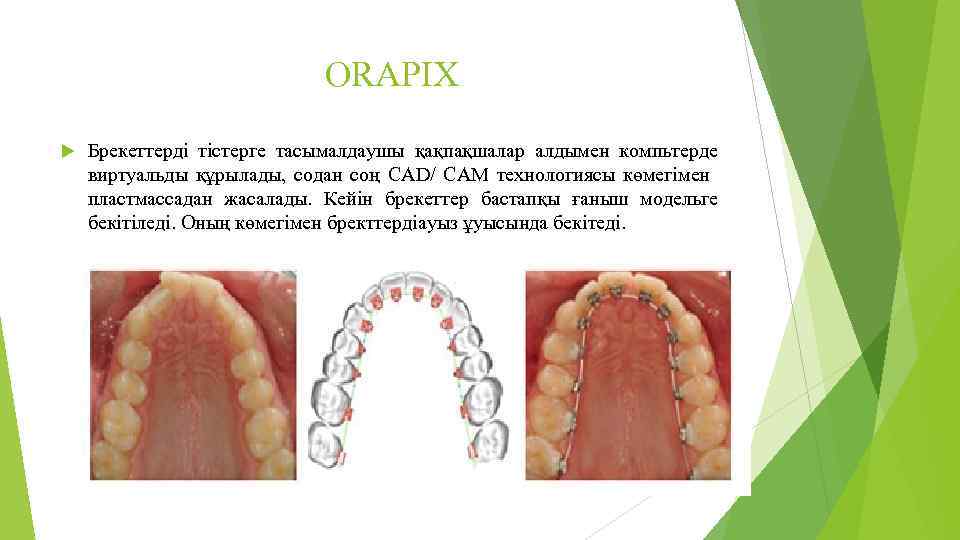 ORAPIX Брекеттерді тістерге тасымалдаушы қақпақшалар алдымен компьтерде виртуальды құрылады, содан соң CAD/ CAM технологиясы