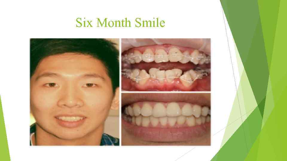 Six Month Smile 