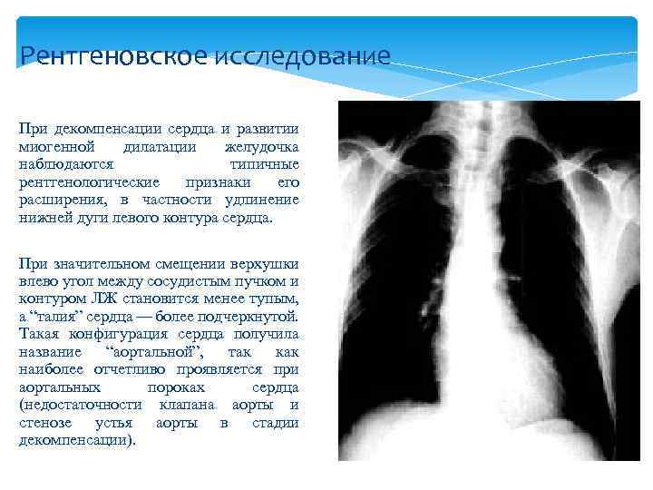 Рентгеновское исследование При декомпенсации сердца и развитии миогенной дилатации желудочка наблюдаются типичные рентгенологические признаки