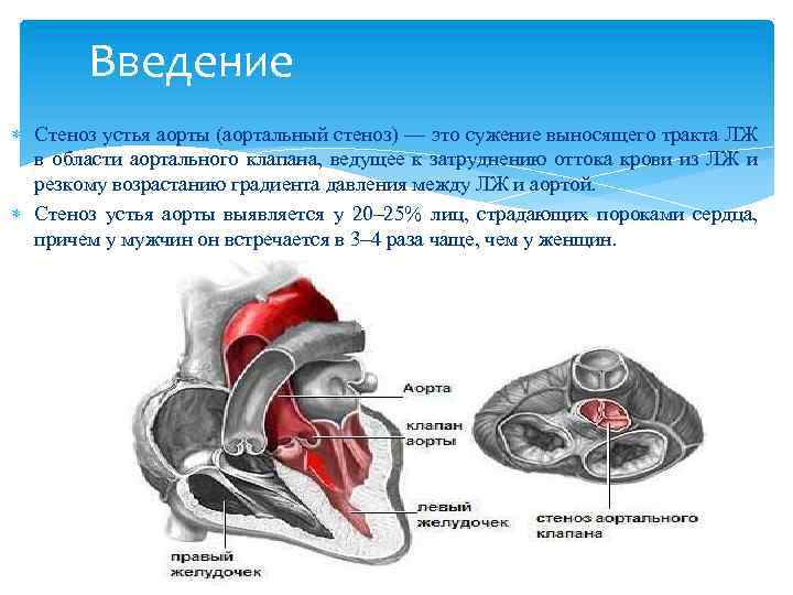 Введение Стеноз устья аорты (аортальный стеноз) — это сужение выносящего тракта ЛЖ в области