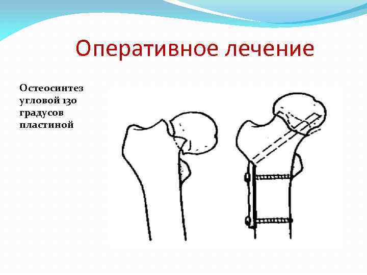 Оперативное лечение Остеосинтез угловой 130 градусов пластиной 