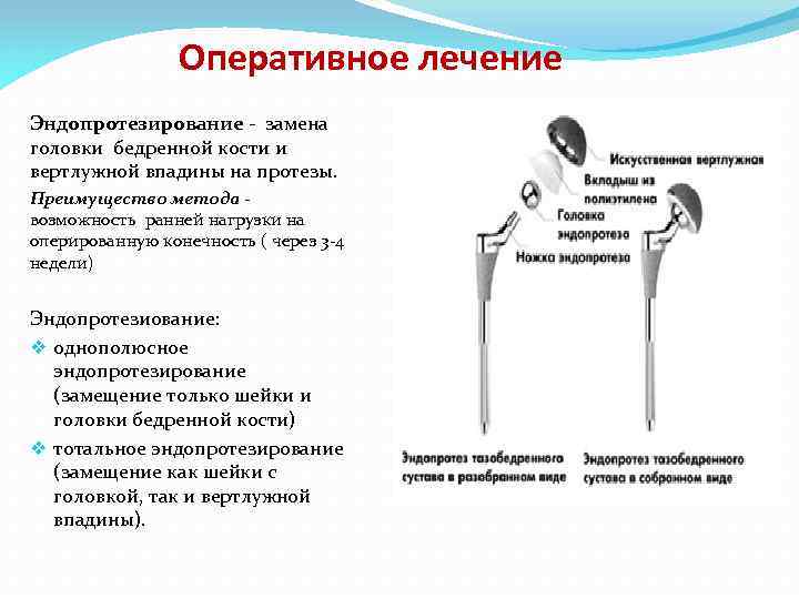 Оперативное лечение Эндопротезирование - замена головки бедренной кости и вертлужной впадины на протезы. Преимущество