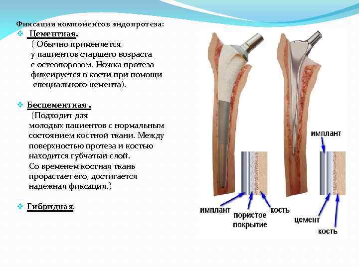 Цементный эндопротез