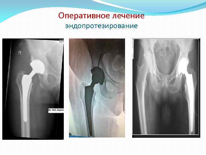 Оперативное лечение эндопротезирование 