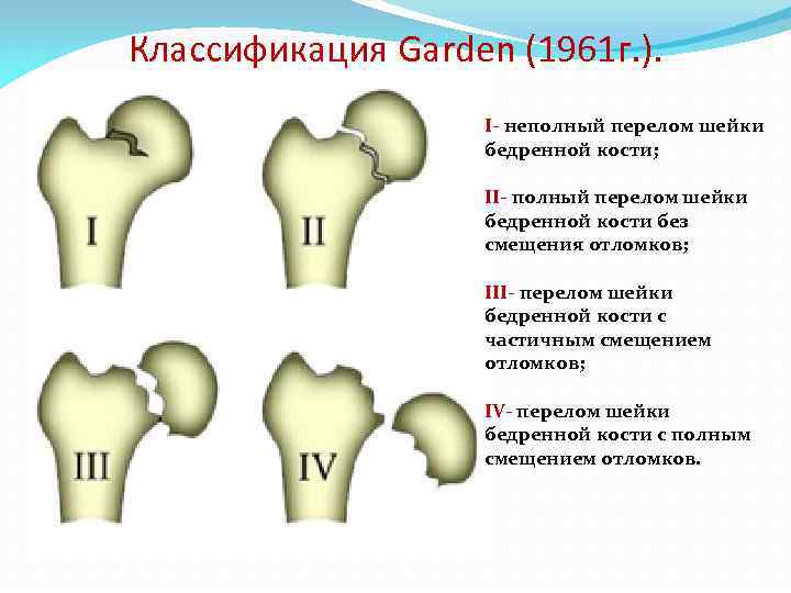 Полная кость. Классификация переломов шейки бедра по Garden. Классификация переломов проксимального отдела бедренной кости. Классификация переломов шейки бедра Пауэльс. Переломы шейки бедра классификация рентген.