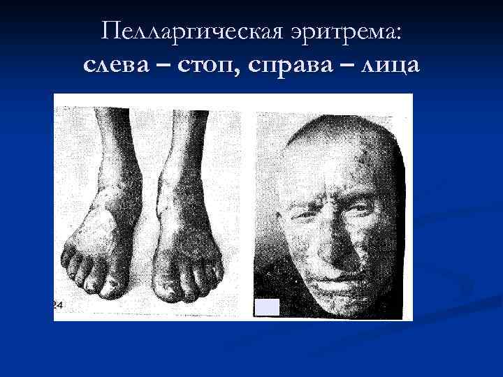 Пелларгическая эритрема: слева – стоп, справа – лица 