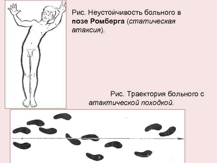 Рис. Неустойчивость больного в позе Ромберга (статическая атаксия). Рис. Траектория больного с атактической походкой.