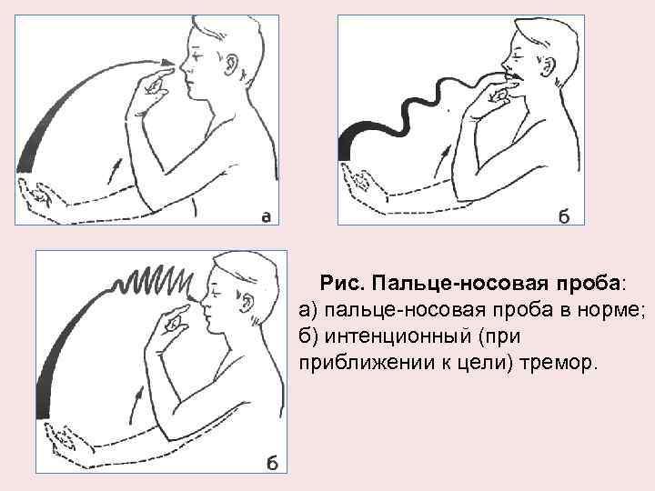 Рис. Пальце-носовая проба: а) пальце-носовая проба в норме; б) интенционный (при приближении к цели)