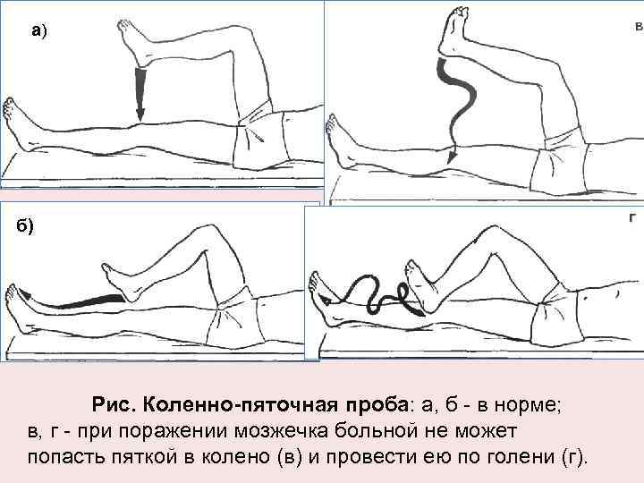 а) б) Рис. Коленно-пяточная проба: а, б - в норме; в, г - при