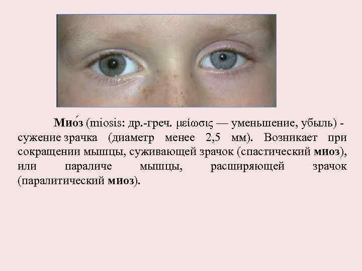 Мио з (miosis: др. -греч. μείωσις — уменьшение, убыль) - сужение зрачка (диаметр менее