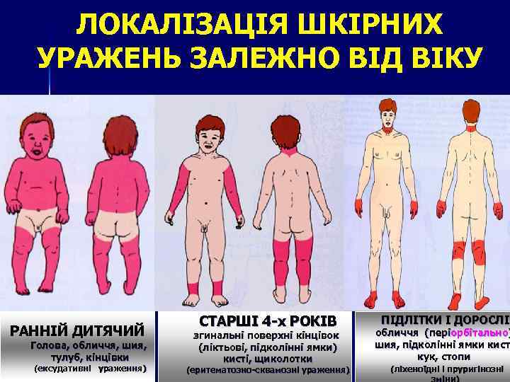ЛОКАЛІЗАЦІЯ ШКІРНИХ УРАЖЕНЬ ЗАЛЕЖНО ВІД ВІКУ РАННІЙ ДИТЯЧИЙ Голова, обличчя, шия, тулуб, кінцівки (ексудативні