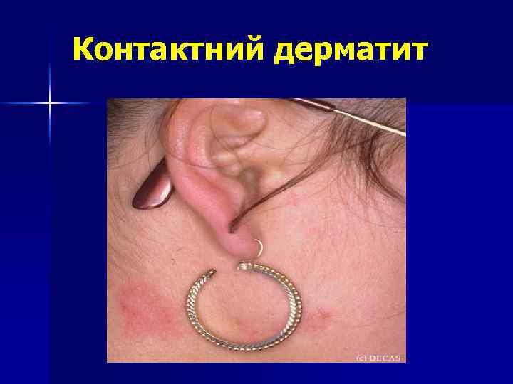 Контактний дерматит 