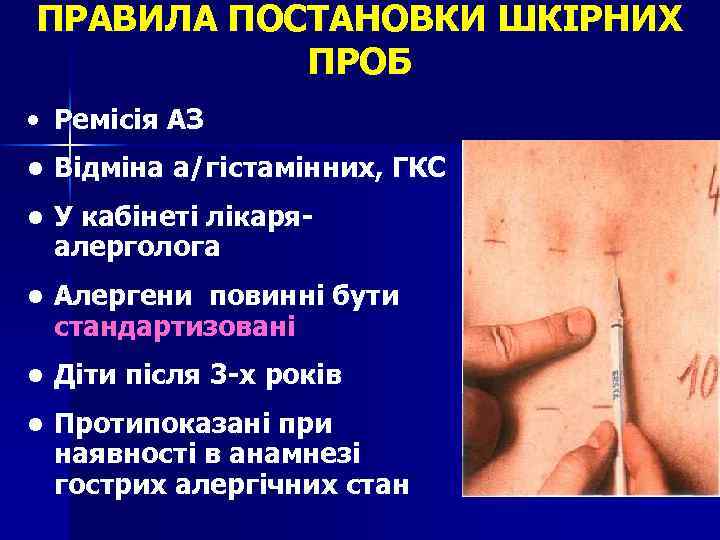ПРАВИЛА ПОСТАНОВКИ ШКІРНИХ ПРОБ • Ремісія АЗ • Відміна а/гістамінних, ГКС • У кабінеті