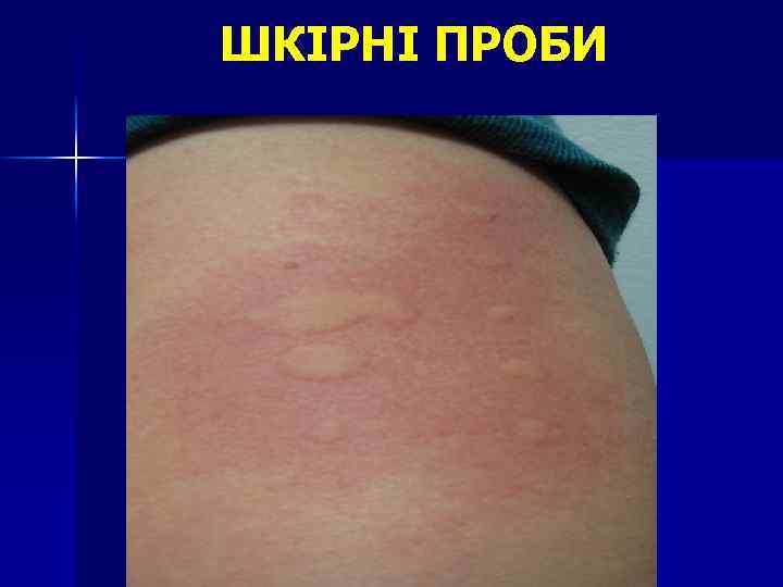 ШКІРНІ ПРОБИ 