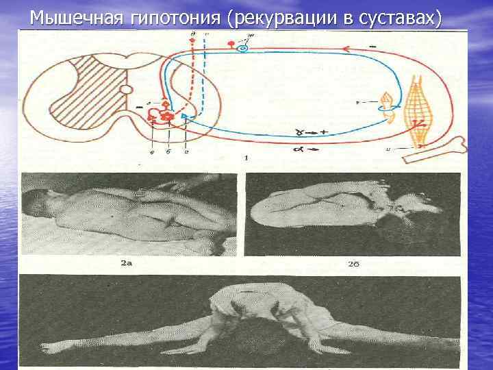 Мышечная гипотония (рекурвации в суставах) 