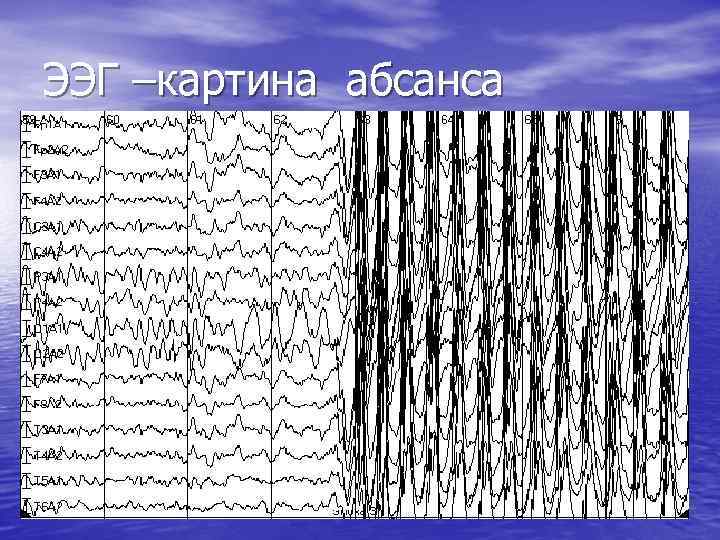 ЭЭГ –картина абсанса 