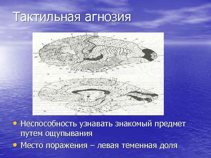 Тактильная агнозия • Неспособность узнавать знакомый предмет • путем ощупывания Место поражения – левая