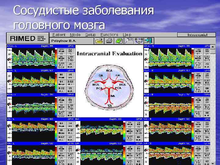 Cосудистые заболевания головного мозга 