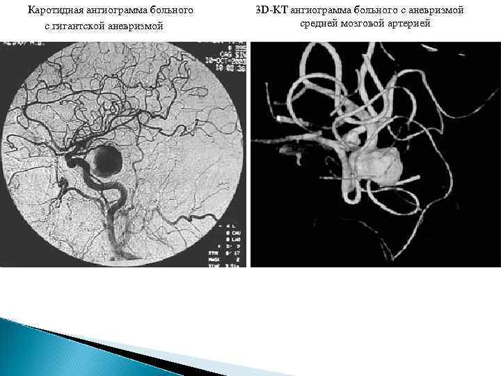  Каротидная ангиограмма больного с гигантской аневризмой 3 D-KT ангиограмма больного с аневризмой средней