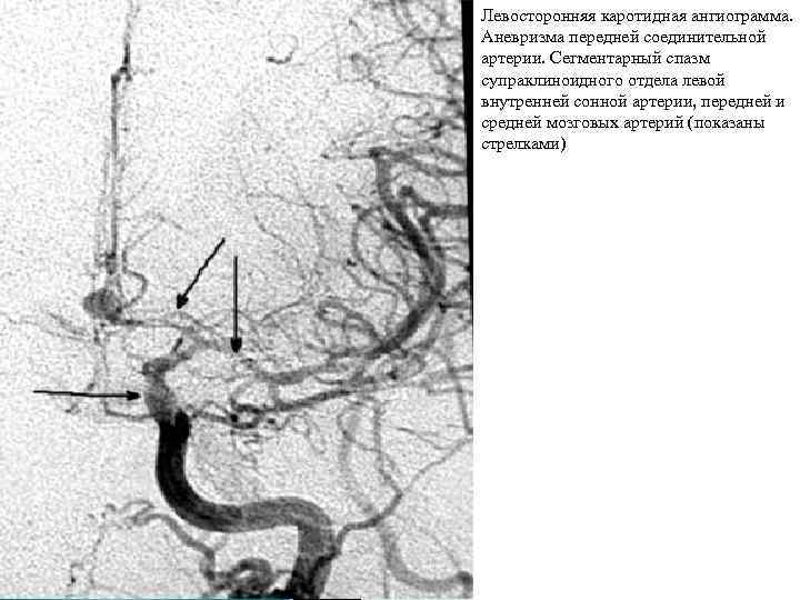 Левосторонняя каротидная ангиограмма. Аневризма передней соединительной артерии. Сегментарный спазм супраклиноидного отдела левой внутренней сонной