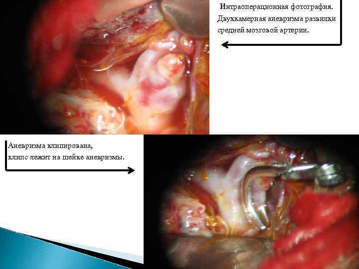 Интраоперационная фотография. Двухкамерная аневризма развилки средней мозговой артерии. Аневризма клипирована, клипс лежит на шейке