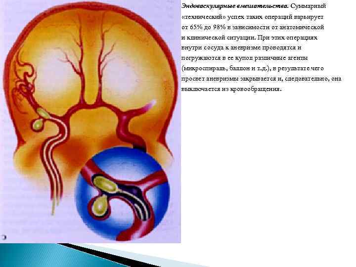 Эндоваскулярные вмешательства. Суммарный «технический» успех таких операций варьирует от 65% до 98% в зависимости