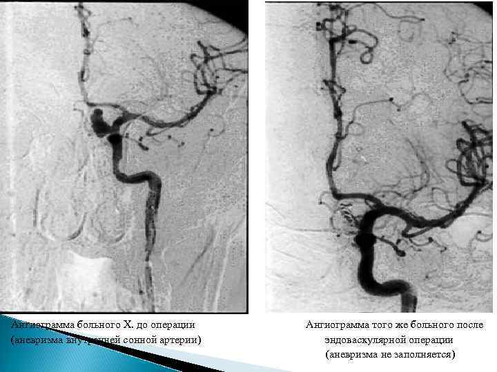 Операции на сонной артерии отзывы пациентов. Мешотчатая аневризма ВСА. Кальцинированная аневризма ВСА. Фузиформное расширение внутренней сонной артерии. Аневризма мешотчатая операция.