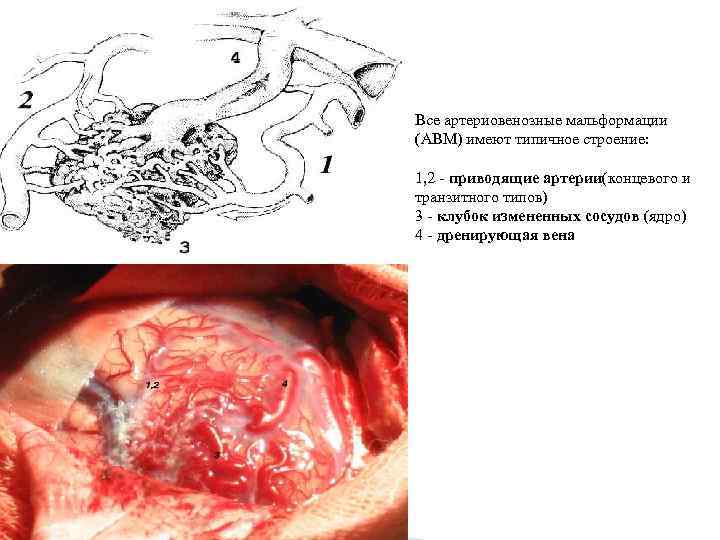 Все артериовенозные мальформации (АВМ) имеют типичное строение: 1, 2 - приводящие артерии(концевого и транзитного