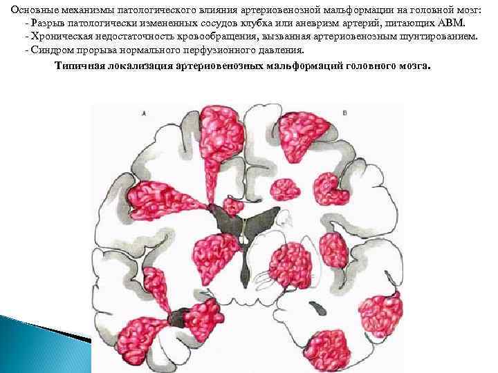 Основные механизмы патологического влияния артериовенозной мальформации на головной мозг: - Разрыв патологически измененных сосудов