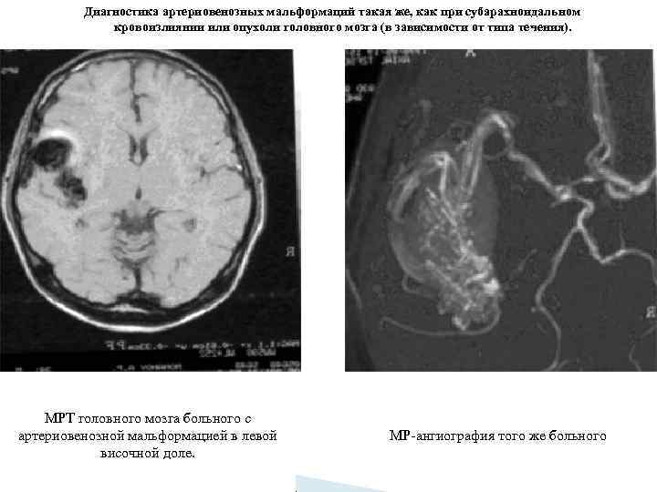 Диагностика артериовенозных мальформаций такая же, как при субарахноидальном кровоизлиянии или опухоли головного мозга (в