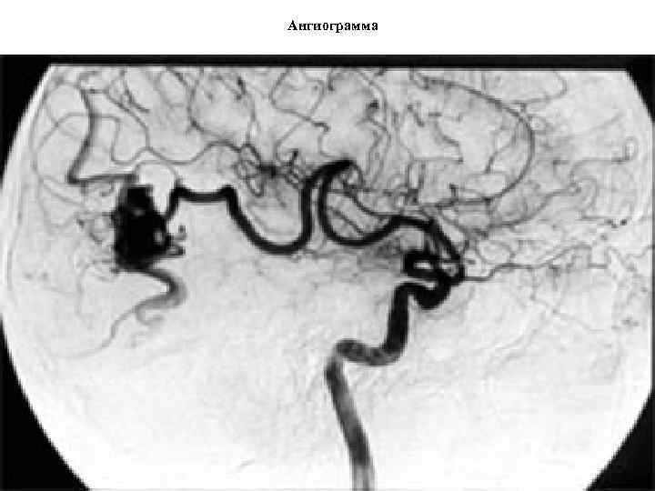 Ангиограмма 