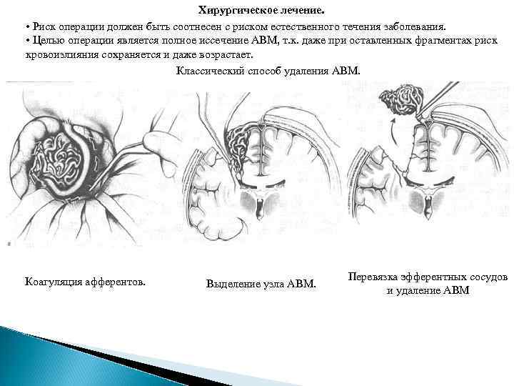 Хирургическое лечение. • Риск операции должен быть соотнесен с риском естественного течения заболевания. •