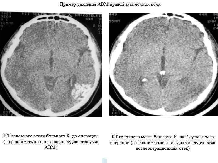 Пример удаления АВМ правой затылочной доли КТ головного мозга больного К. до операции (в