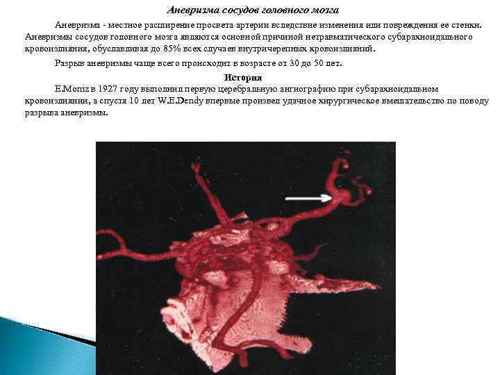 Аневризма сосудов головного мозга Аневризма - местное расширение просвета артерии вследствие изменения или повреждения