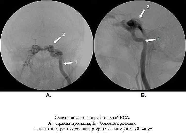 Селективная ангиография левой ВСА. А. - прямая проекция; Б. - боковая проекция. 1 -