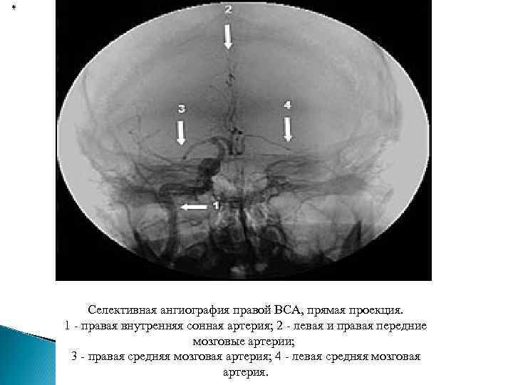 * Селективная ангиография правой ВСА, прямая проекция. 1 - правая внутренняя сонная артерия; 2