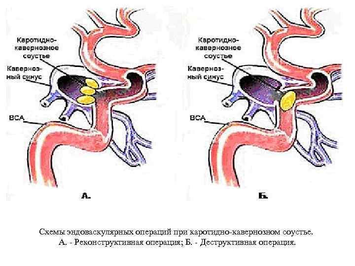 Схемы эндоваскулярных операций при каротидно-кавернозном соустье. А. - Реконструктивная операция; Б. - Деструктивная операция.