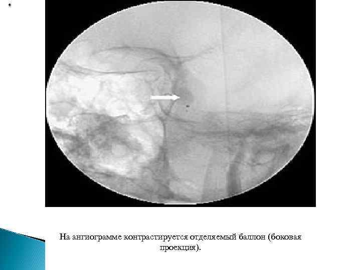 * На ангиограмме контрастируется отделяемый баллон (боковая проекция). 