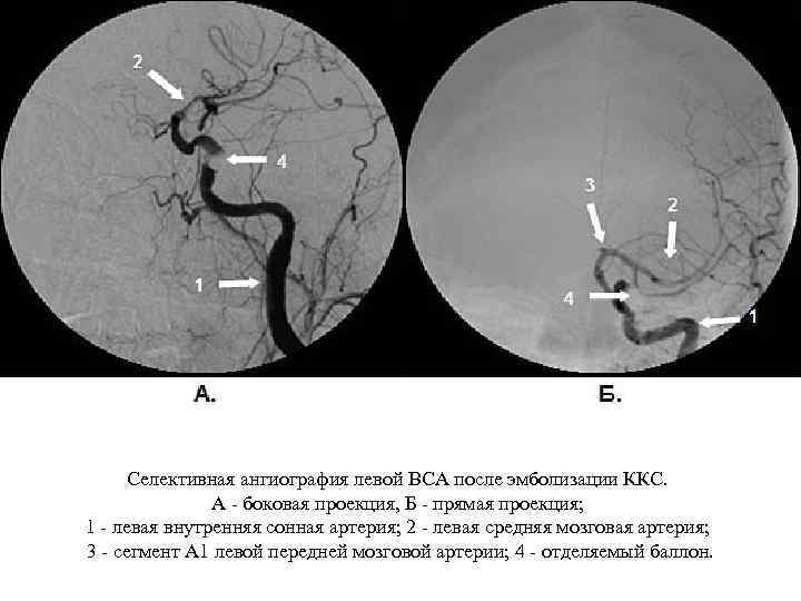 Селективная ангиография левой ВСА после эмболизации ККС. А - боковая проекция, Б - прямая
