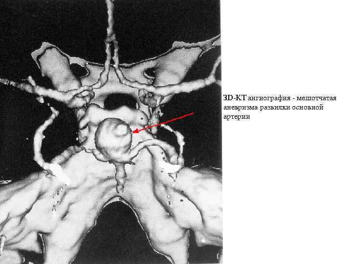 ЗD-KT ангиография - мешотчатая аневризма развилки основной артерии 