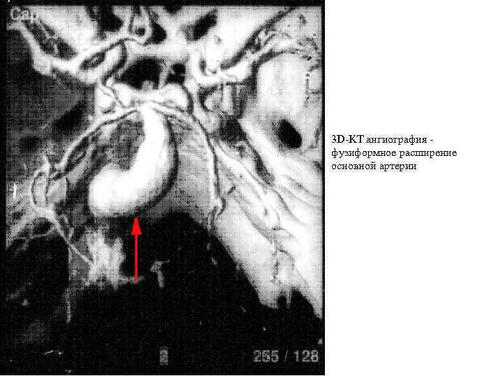 3 D-KT ангиография - фузиформное расширение основной артерии 