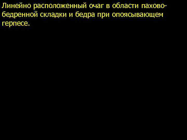 Линейно расположенный очаг в области паховобедренной складки и бедра при опоясывающем герпесе. 