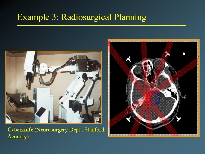 Example 3: Radiosurgical Planning Cyberknife (Neurosurgery Dept. , Stanford, Accuray) 