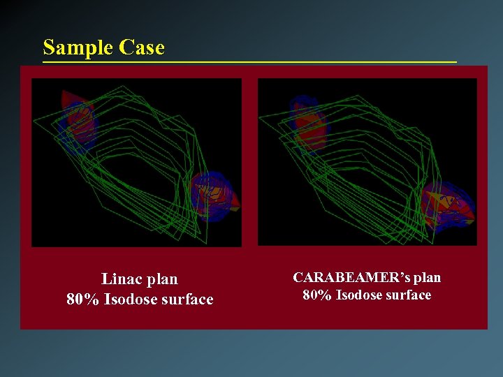 Sample Case Linac plan 80% Isodose surface CARABEAMER’s plan 80% Isodose surface 