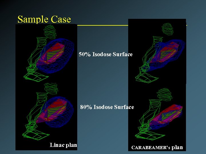 Sample Case 50% Isodose Surface 80% Isodose Surface Linac plan CARABEAMER’s plan 