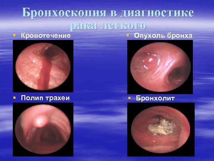 Бронхоскопия в диагностике рака легкого § Кровотечение § Опухоль бронха § Полип трахеи §
